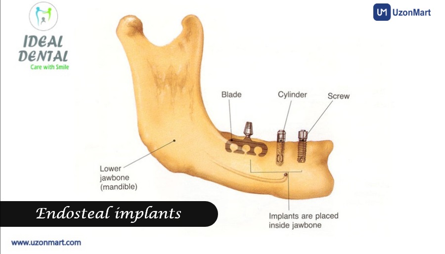 Dental Implants in Thane