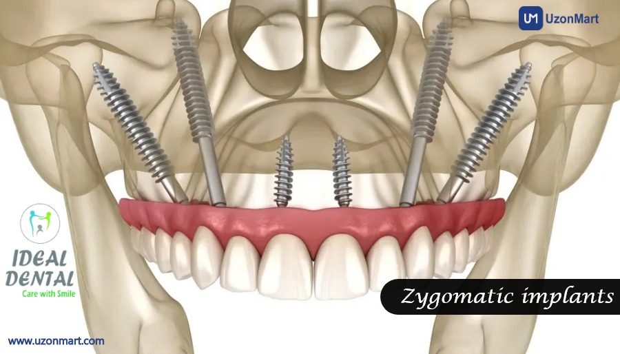 Dental Implants in Thane