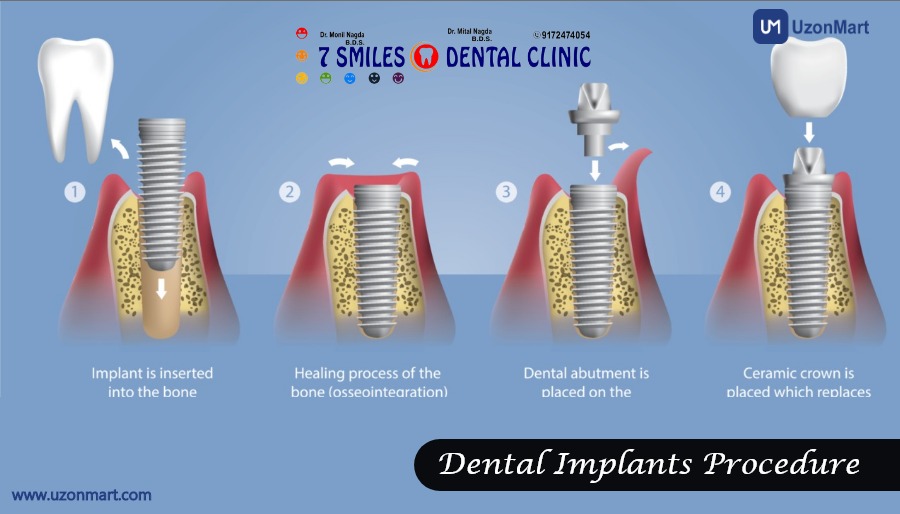 Dental Implants in Mulund