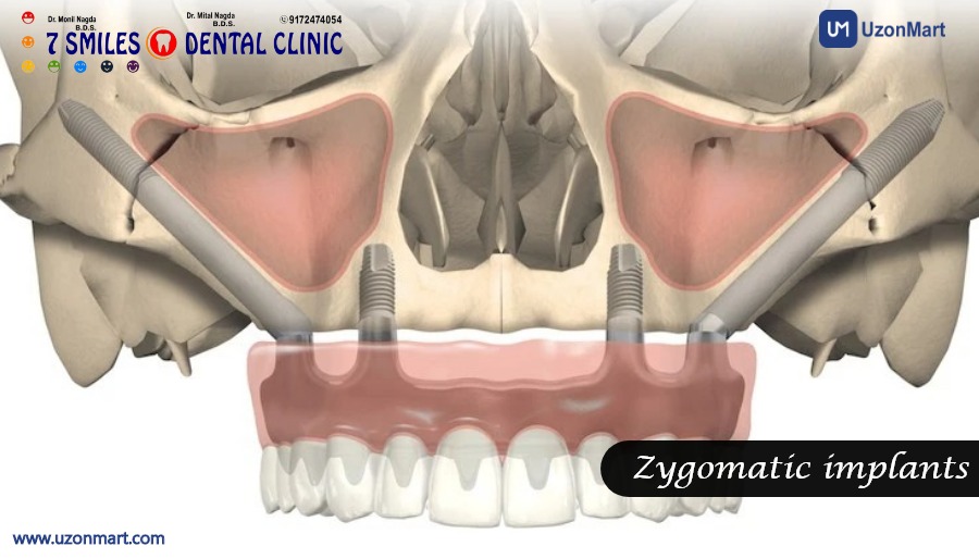 Dental Implants in Mulund