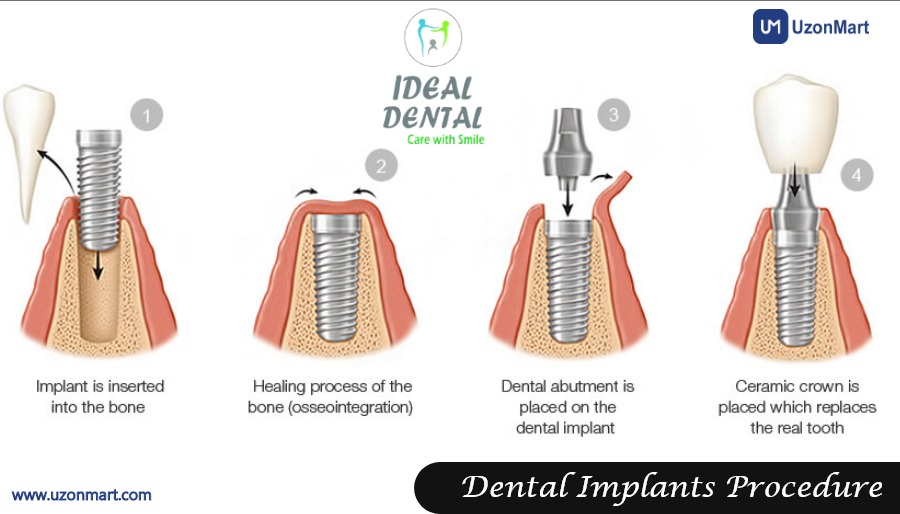 Dental Implants in Thane