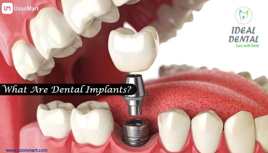 Dental Implants in Thane