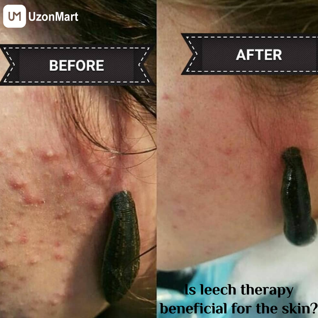 Leech Therapy in Mumbai