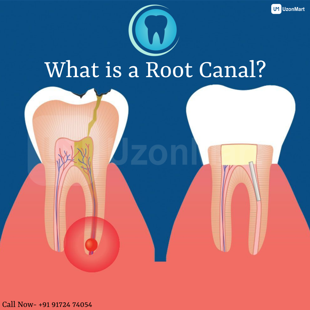 Root Canal Treatment in Mulund