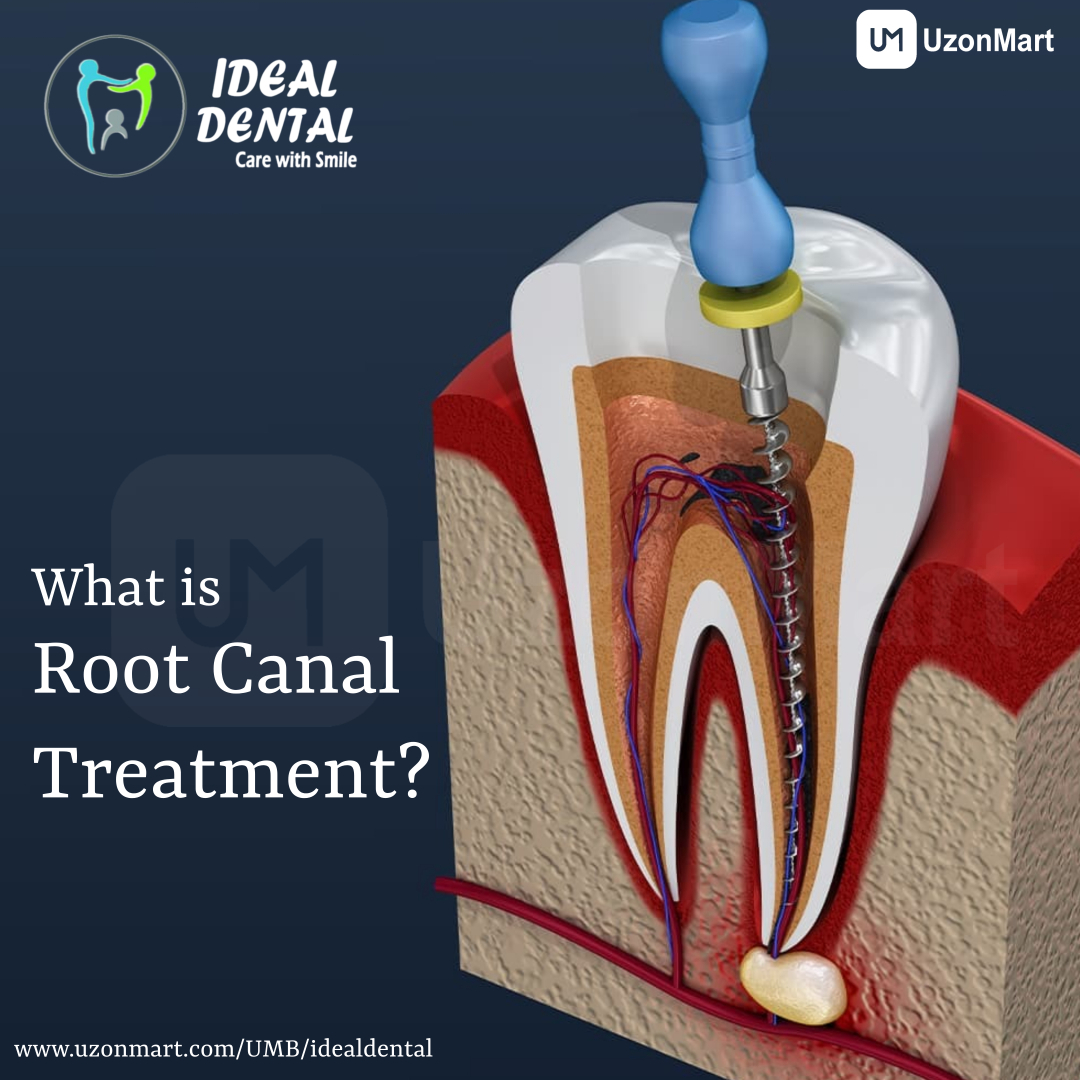  Root Canal Treatment in Thane 