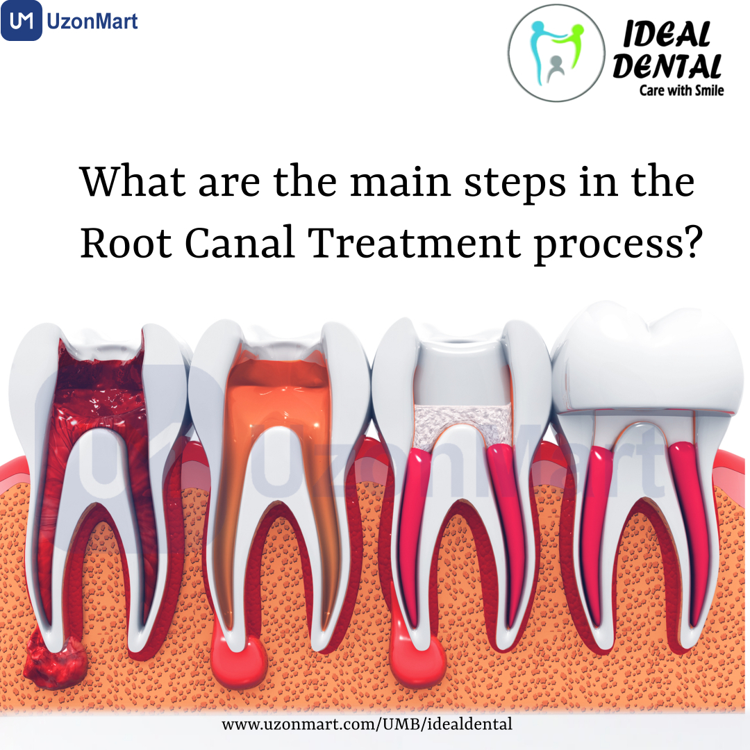  Root Canal Treatment in Thane 