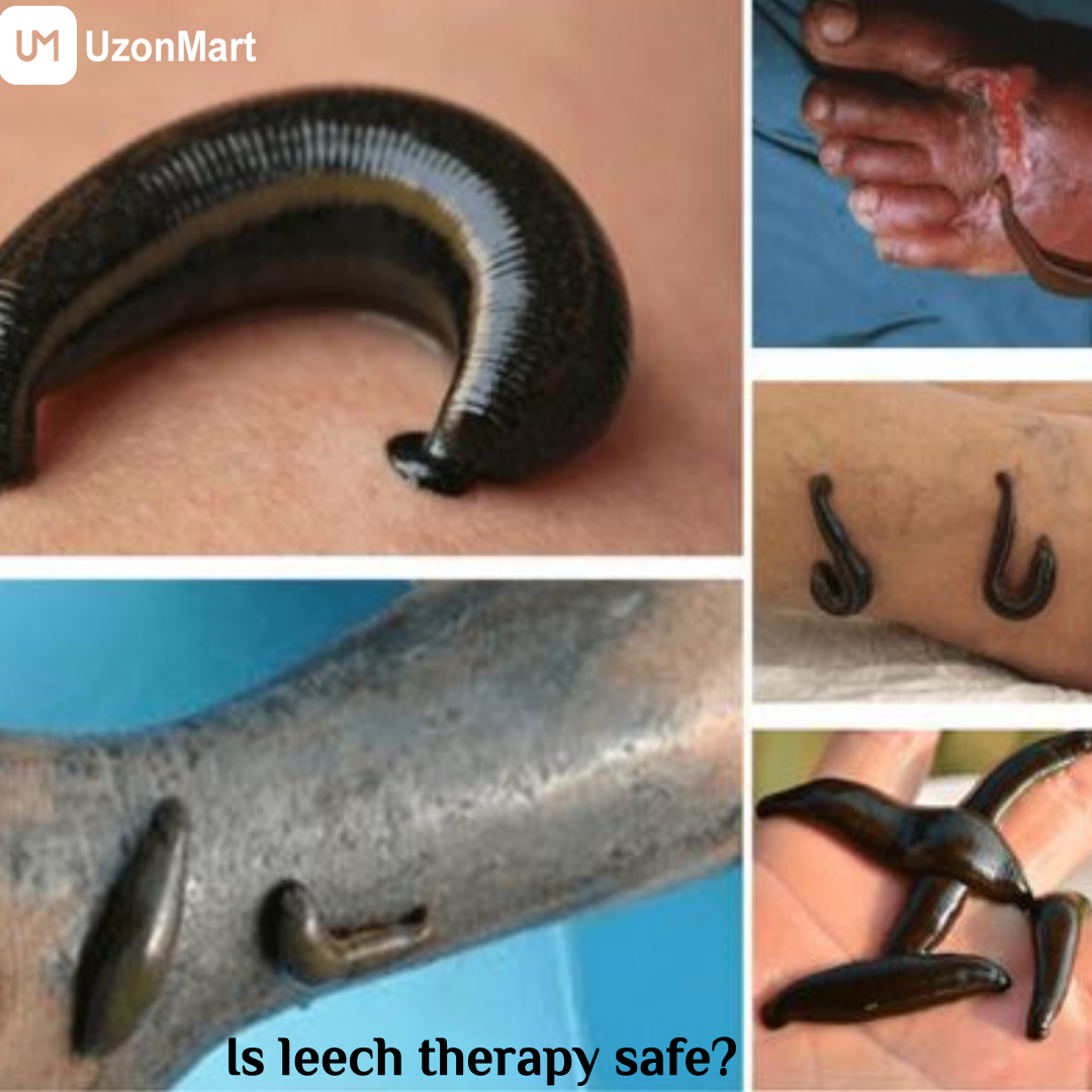 Leech Therapy in Mumbai