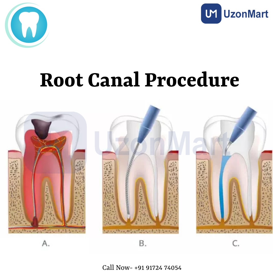 Root Canal Treatment in Mulund